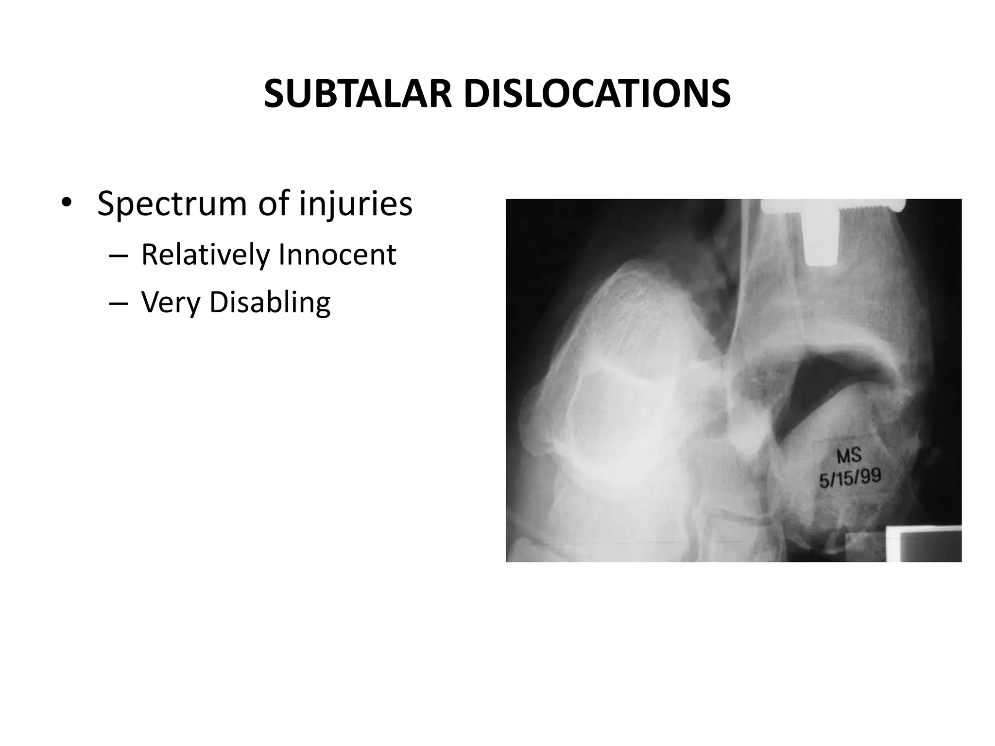 SUBTALAR DISLOCATIONS
• Spectrum of injuries
– Relatively Innocent
– Very Disabling
 