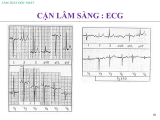 TÂM THẤT ĐỘC NHẤT
10
CẬN LÂM SÀNG : ECG
 