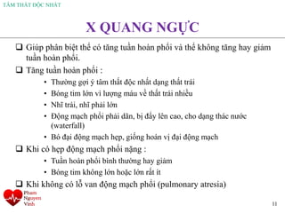 TÂM THẤT ĐỘC NHẤT
11
X QUANG NGỰC
❑ Giúp phân biệt thể có tăng tuần hoàn phổi và thể không tăng hay giảm
tuần hoàn phổi.
❑ Tăng tuần hoàn phổi :
• Thường gợi ý tâm thất độc nhất dạng thất trái
• Bóng tim lớn vì lượng máu về thất trái nhiều
• Nhĩ trái, nhĩ phải lớn
• Động mạch phổi phải dãn, bị đẩy lên cao, cho dạng thác nước
(waterfall)
• Bó đại động mạch hẹp, giống hoán vị đại động mạch
❑ Khi có hẹp động mạch phổi nặng :
• Tuần hoàn phổi bình thường hay giảm
• Bóng tim không lớn hoặc lớn rất ít
❑ Khi không có lỗ van động mạch phổi (pulmonary atresia)
 