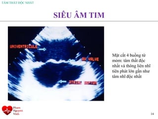 TÂM THẤT ĐỘC NHẤT
14
SIÊU ÂM TIM
Mặt cắt 4 buồng từ
mỏm: tâm thất độc
nhất và thông liên nhĩ
tiên phát lớn gần như
tâm nhĩ độc nhất
 