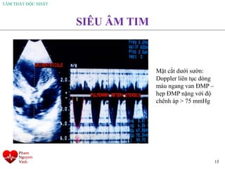 TÂM THẤT ĐỘC NHẤT
15
SIÊU ÂM TIM
Mặt cắt dưới sườn:
Doppler liên tục dòng
máu ngang van ĐMP –
hẹp ĐMP nặng với độ
chênh áp > 75 mmHg
 