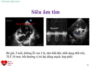 TÂM THẤT ĐỘC NHẤT
Siêu âm tim
16
Bé gái, 5 tuổi, không lỗ van 3 lá, tâm thất độc nhất dạng thất trái,
TLT 10 mm, bất thường vị trí đại động mạch, hẹp phổi
TT Hẹp phổi
Dạng “Single inlet”
 