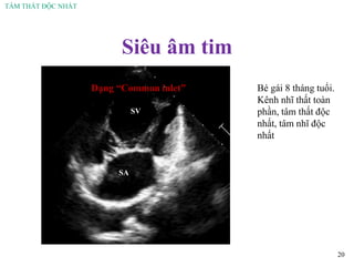 TÂM THẤT ĐỘC NHẤT
Siêu âm tim
20
SV
SA
Dạng “Common inlet” Bé gái 8 tháng tuổi.
Kênh nhĩ thất toàn
phần, tâm thất độc
nhất, tâm nhĩ độc
nhất
 