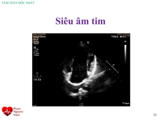 TÂM THẤT ĐỘC NHẤT
Siêu âm tim
21
 