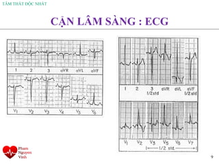 TÂM THẤT ĐỘC NHẤT
9
CẬN LÂM SÀNG : ECG
 
