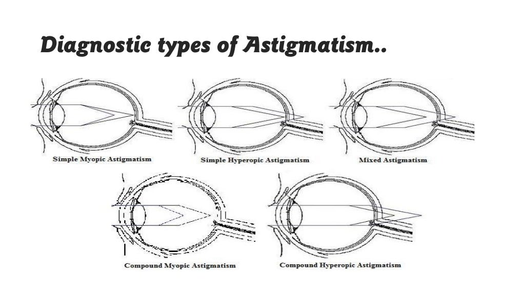 Static retinoscope presentation by Tamalika