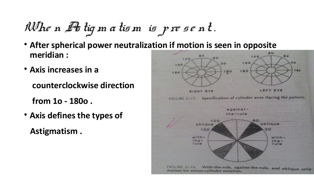 Static retinoscope presentation by Tamalika