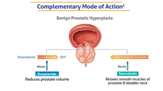 Comprehensive Overview and Management of Benign Prostatic Hyperplasia ...