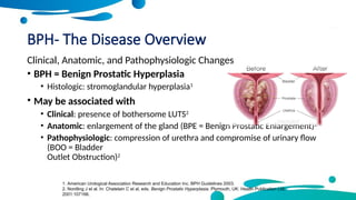 Comprehensive Overview and Management of Benign Prostatic Hyperplasia ...