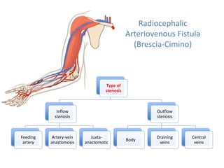 Radiocephalic
Arteriovenous Fistula
(Brescia-Cimino)
Type of
stenosis
Inflow
stenosis
Feeding
artery
Artery-vein
anastomosis
Juxta-
anastomotic
Outflow
stenosis
Body
Draining
veins
Central
veins
 