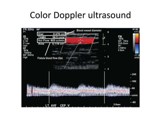 Color Doppler ultrasound
 