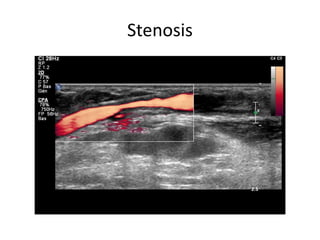 Stenosis
 