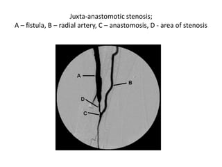 Juxta-anastomotic stenosis;
A – fistula, B – radial artery, C – anastomosis, D - area of stenosis
 
