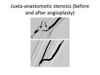 Juxta-anastomotic stenosis (before
and after angioplasty)
 