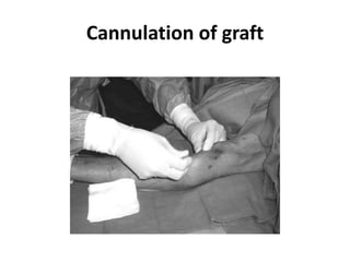 Cannulation of graft
 
