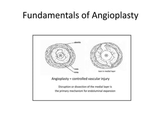 Fundamentals of Angioplasty
 