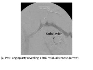 (C) Post- angioplasty revealing < 30% residual stenosis (arrow).
 