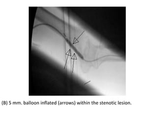(B) 5 mm. balloon inflated (arrows) within the stenotic lesion.
 