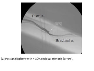 (C) Post angioplasty with < 30% residual stenosis (arrow).
 