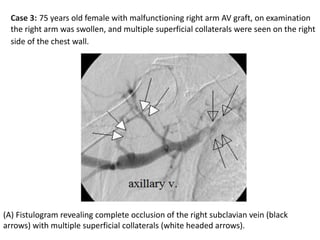 (A) Fistulogram revealing complete occlusion of the right subclavian vein (black
arrows) with multiple superficial collaterals (white headed arrows).
Case 3: 75 years old female with malfunctioning right arm AV graft, on examination
the right arm was swollen, and multiple superficial collaterals were seen on the right
side of the chest wall.
 
