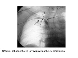 (B) 9 mm. balloon inflated (arrows) within the stenotic lesion.
.
.
 
