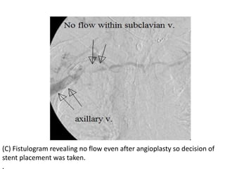 (C) Fistulogram revealing no flow even after angioplasty so decision of
stent placement was taken.
.
 