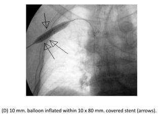 (D) 10 mm. balloon inflated within 10 x 80 mm. covered stent (arrows).
 