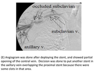 (E) Angiogram was done after deploying the stent, and showed partial
opening of the central vein. Decision was done to put another stent in
the axillary vein overlapping the proximal stent because there were
some clots in that area.
 