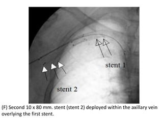 (F) Second 10 x 80 mm. stent (stent 2) deployed within the axillary vein
overlying the first stent.
 