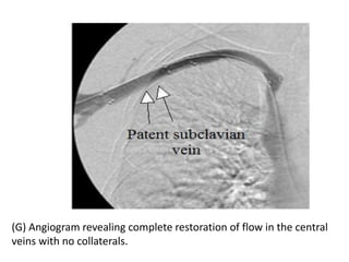 (G) Angiogram revealing complete restoration of flow in the central
veins with no collaterals.
 