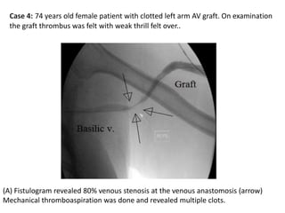 (A) Fistulogram revealed 80% venous stenosis at the venous anastomosis (arrow)
Mechanical thromboaspiration was done and revealed multiple clots.
Case 4: 74 years old female patient with clotted left arm AV graft. On examination
the graft thrombus was felt with weak thrill felt over..
 