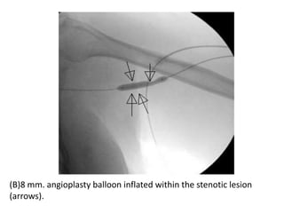 (B)8 mm. angioplasty balloon inflated within the stenotic lesion
(arrows).
 
