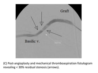 (C) Post-angioplasty and mechanical thromboaspiration fistulogram
revealing < 30% residual stenosis (arrows).
 