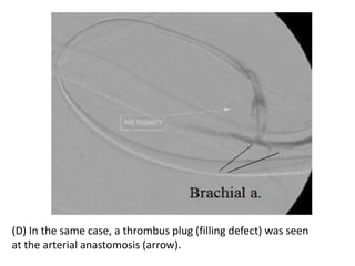 (D) In the same case, a thrombus plug (filling defect) was seen
at the arterial anastomosis (arrow).
 