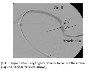 (E) Fistulogram after using Fogarty catheter to pull out the arterial
plug…no filling defects left (arrows).
 