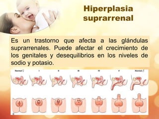 Hiperplasia
suprarrenal
Es un trastorno que afecta a las glándulas
suprarrenales. Puede afectar el crecimiento de
los genitales y desequilibrios en los niveles de
sodio y potasio.
 