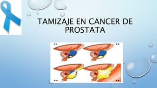 TAMIZAJE EN CANCER DE
PROSTATA
 