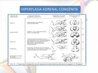 HIPERPLASIA ADRENAL CONGÉNITA
 