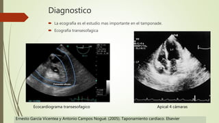 Diagnostico
 La ecografía es el estudio mas importante en el tamponade.
 Ecografía transesofagica
Ecocardiograma transesofagico Apical 4 cámaras
Ernesto García Vicentea y Antonio Campos Nogué. (2005). Taponamiento cardíaco. Elsevier
 