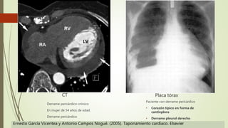 Placa tórax
Paciente con derrame pericárdico
• Corazón típico en forma de
cantinplora
• Derrame pleural derecho
CT
Derrame pericárdico crónico
En mujer de 54 años de edad.
Derrame pericárdico
Ernesto García Vicentea y Antonio Campos Nogué. (2005). Taponamiento cardíaco. Elsevier
 