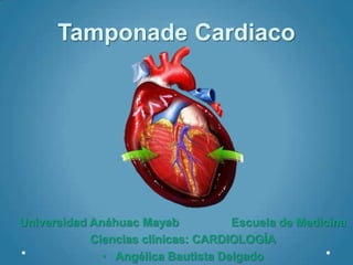 Tamponade Cardiaco




Universidad Anáhuac Mayab           Escuela de Medicina
            Ciencias clínicas: CARDIOLOGÍA
              • Angélica Bautista Delgado
 