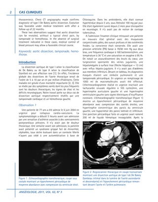 2

CAS CLINIQUES
thoracentesis. Chest CT angiography made confirms
diagnostic of type I De Bakey aortic dissection. Evolution
was favorable under medical treatment with after a
follow-up of 22 months.
These two observations suggest that aortic dissection
can be revealed, without a typical chest pain, by
tamponade or hemothorax. In the absence of surgical
treatment indicated in these cases, medical control of
blood pressure may allow a favorable clinical course.

Keywords: aortic dissection, tamponade, hemothorax.
Introduction
La dissection aortique de type I selon la classification
de De Bakey ou de type A selon la classification de
Stanford est une affection rare [1]. En effet, l’incidence
globale des dissections de l’aorte thoracique serait de
l’ordre de 5 à 10 par an et par million d’habitants. Cette
maladie est grevée d’une mortalité importante [2, 3]. Elle
se révèle par des symptômes variés dont les plus fréquents
sont les douleurs thoraciques, les signes de choc et les
déficits neurologiques. Notre travail porte sur deux cas de
dissection aortique respectivement révélés par une
tamponnade cardiaque et un hémothorax gauche.

Observation 1
Une patiente de 77 ans a été admise le 6 juin 2004 en
urgence pour collapsus cardio-vasculaire. La
symptomatologie a débuté 5 heures avant son admission
par une sensation d’asthénie associée à des vomissements
postprandiaux précoces. Il n’y avait pas de douleur
thoracique. Une semaine avant son admission, la patiente
avait présenté un syndrome grippal fait de rhinorrhée,
céphalées, toux sèche évoluant dans un contexte fébrile
n’ayant pas cédé à une automédication à base de

Figure 1 : Echocardiographie transthoracique, coupe sous
costale montrant un épanchement péricardique de
moyenne abondance avec compression du ventricule droit.
ANGÉIOLOGIE, 2011, VOL. 63, N° 3

Chloroquine. Dans les antécédents, elle était connue
hypertendue depuis 5 ans, sous Aténolol 100 mg par jour.
Elle était également suivie depuis 2 mois pour discopathie
en neurologie. Il n’y avait pas de notion de contage
tuberculeux.
A l’admission l’examen clinique retrouvait une patiente
en mauvais état général avec des muqueuses
conjonctivales pâles, des sueurs profuses et des extrémités
froides. La conscience était conservée. Elle avait une
pression artérielle (PA) basse à 70/40 mm Hg aux deux
bras, une fréquence cardiaque à 100 battements/min, une
température à 36 °C et une saturation en oxygène à 95 %.
On notait un assourdissement des bruits du cœur, une
turgescence spontanée des veines jugulaires, une
hépatomégalie à surface lisse (flèche hépatique = 13 cm)
avec reflux hépato-jugulaire. Il n`y avait pas d’œdèmes
aux membres inférieurs. Devant ce tableau, les diagnostics
évoqués étaient une embolie pulmonaire et une
tamponnade péricardique. En urgence un remplissage de
1000 ml de macromolécules avait été effectué.
L’électrocardiogramme réalisé en urgence inscrivait une
tachycardie sinusale régulière à 105 cycles/min, une
hypertrophie auriculaire gauche et une hypertrophie
ventriculaire gauche sans signes électriques d’insuffisance
coronaire. L’échocardiographie transthoracique (figure 1)
montra un épanchement péricardique de moyenne
abondance avec compression des cavités droites, une
hypertrophie concentrique des parois du ventricule
gauche, une hypocinésie des parois latérale et inférieure.
Une ponction péricardique faite en urgence avait ramené
200 ml de liquide hématique incoagulable. Après la

Figure 2: Angioscanner thoracique en coupe transversale
montrant une dissection aortique de type I de De Bakey
(lambeau intimal dans la lumière de l’aorte ascendante
et descendante) et l’épanchement péricardique remontant devant l’aorte et l’artère pulmonaire.

 