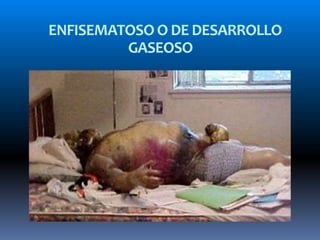 ENFISEMATOSO O DE DESARROLLO
GASEOSO
 