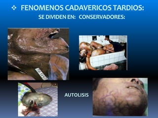  FENOMENOS CADAVERICOS TARDIOS:
SEDIVIDENEN: CONSERVADORES:
AUTOLISIS
 