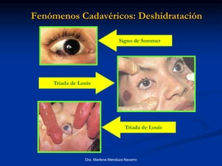 Dra. Marlene Mendoza Navarro
Fenómenos Cadavéricos: Deshidratación
Triada de Louis
Signo de Sommer
Triada de Louis
 