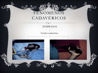 FENÓMENOS
CADAVÉRICOS
TEMPRANOS
Lividez cadavérica
 