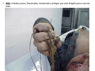 • Mão: 4 dedos juntos, flexionados, recobrindo o polegar que está dirigido para o oco da
mão.
 