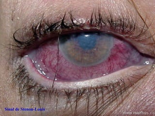 Sinal de Stenon-Louis
 