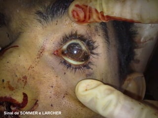 Sinal de SOMMER e LARCHER
 