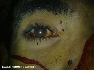 Sinal de SOMMER e LARCHER
 